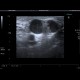 Tumorous infiltration of lymph node: US - Ultrasound